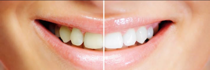 bright and beautiful teeth in a happy smile