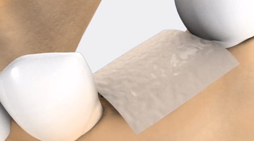 bone augmentation image