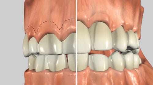 crown lengthening image