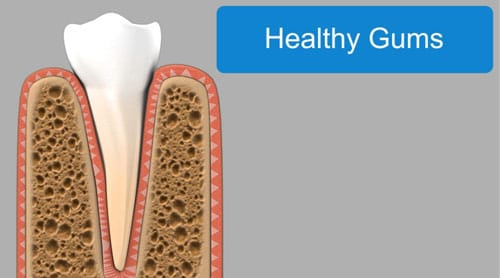 gum disease image