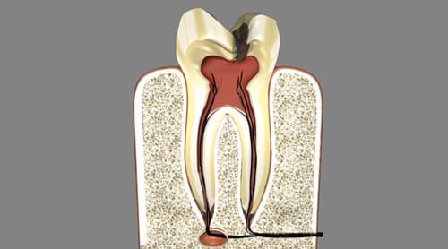 root canal image