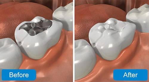 tooth colored filling image