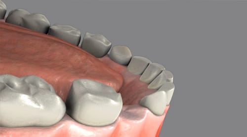 tooth extraction image