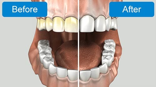 teeth whitening image